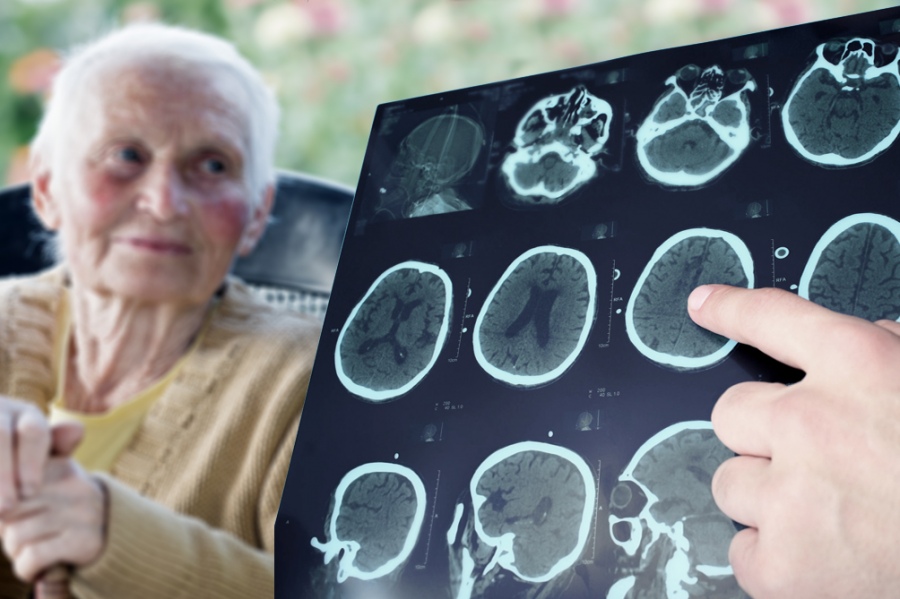 Un paso para detectar el Alzheimer
