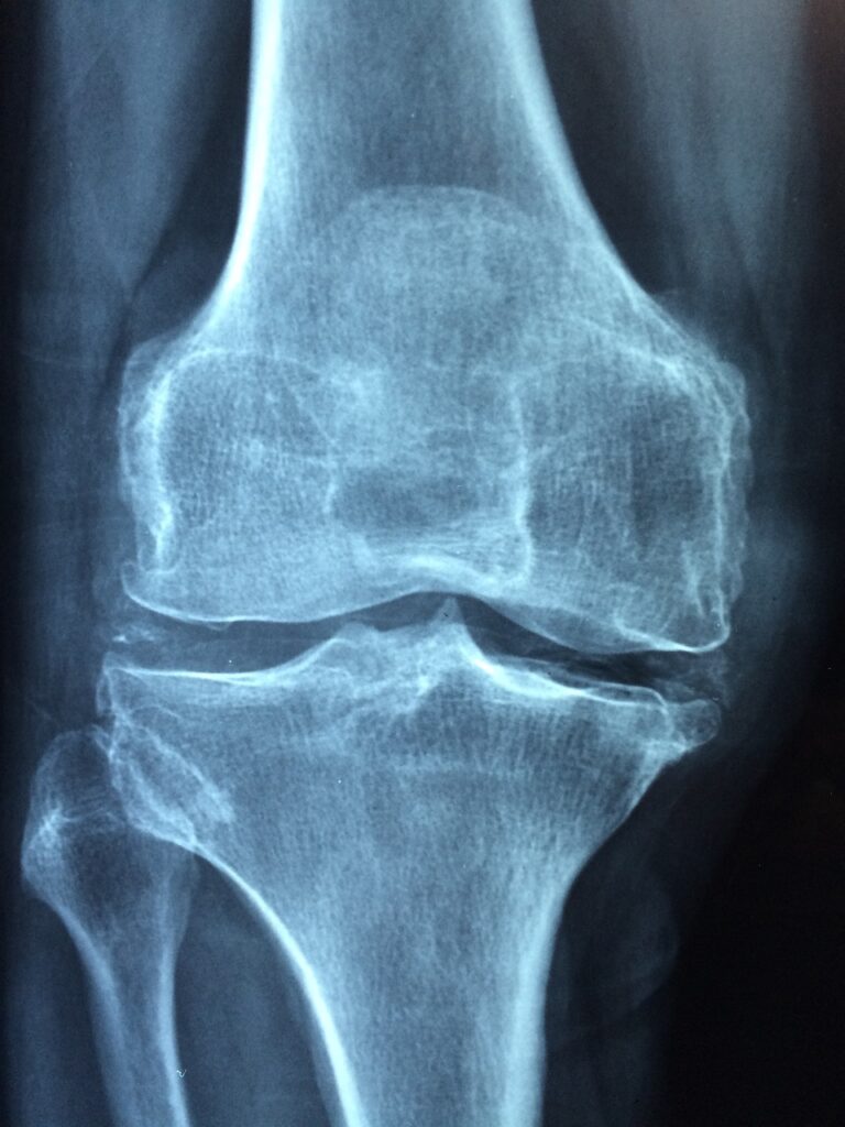 Un nuevo análisis de sangre que puede identificar la progresión de la artrosis de rodilla, y que es más preciso que los métodos actuales